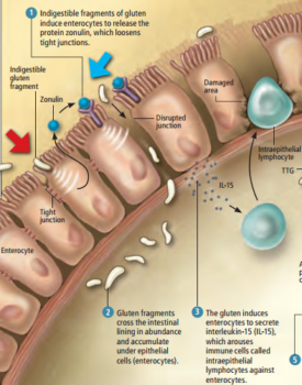 Celiac-Disease-Intraepithelial-lymphocytes