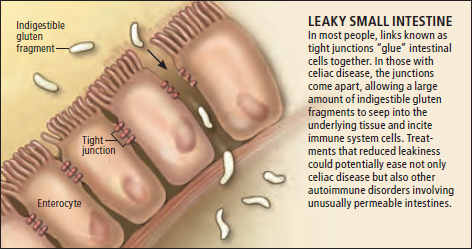 Celiac-Disease-Leaky-Gut